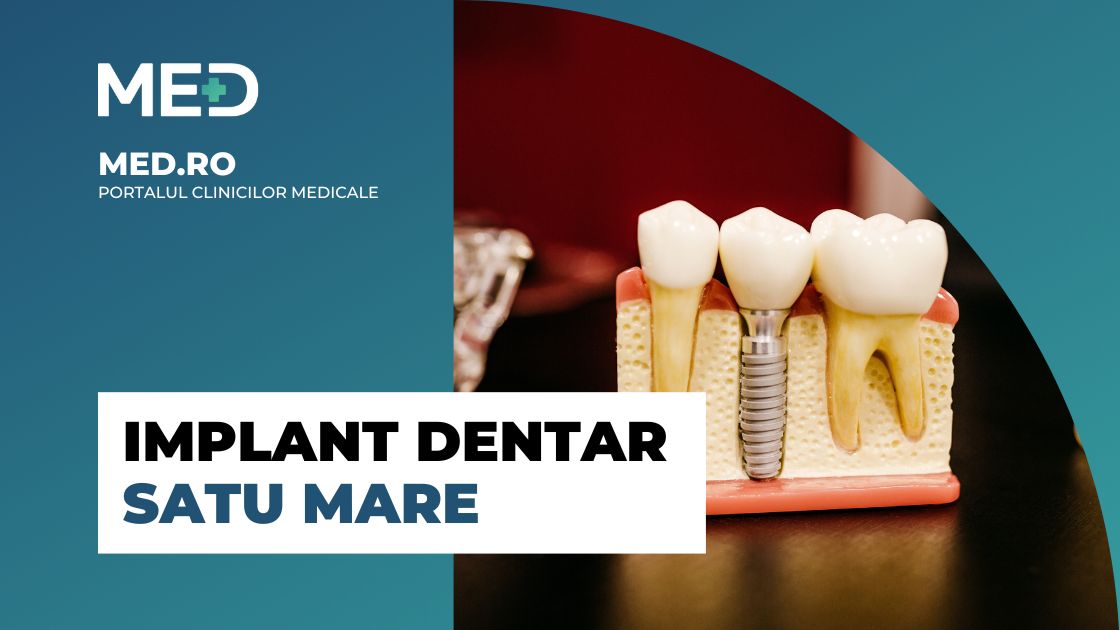 Implant Dentar Satu Mare Top Clinici Pre Uri Programare Online