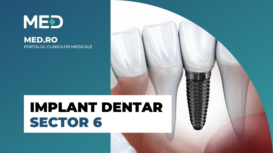 Tranquility Pinion Stun Implant Dentar Sector 4 - Top 5 Clinici verificate - Med.ro