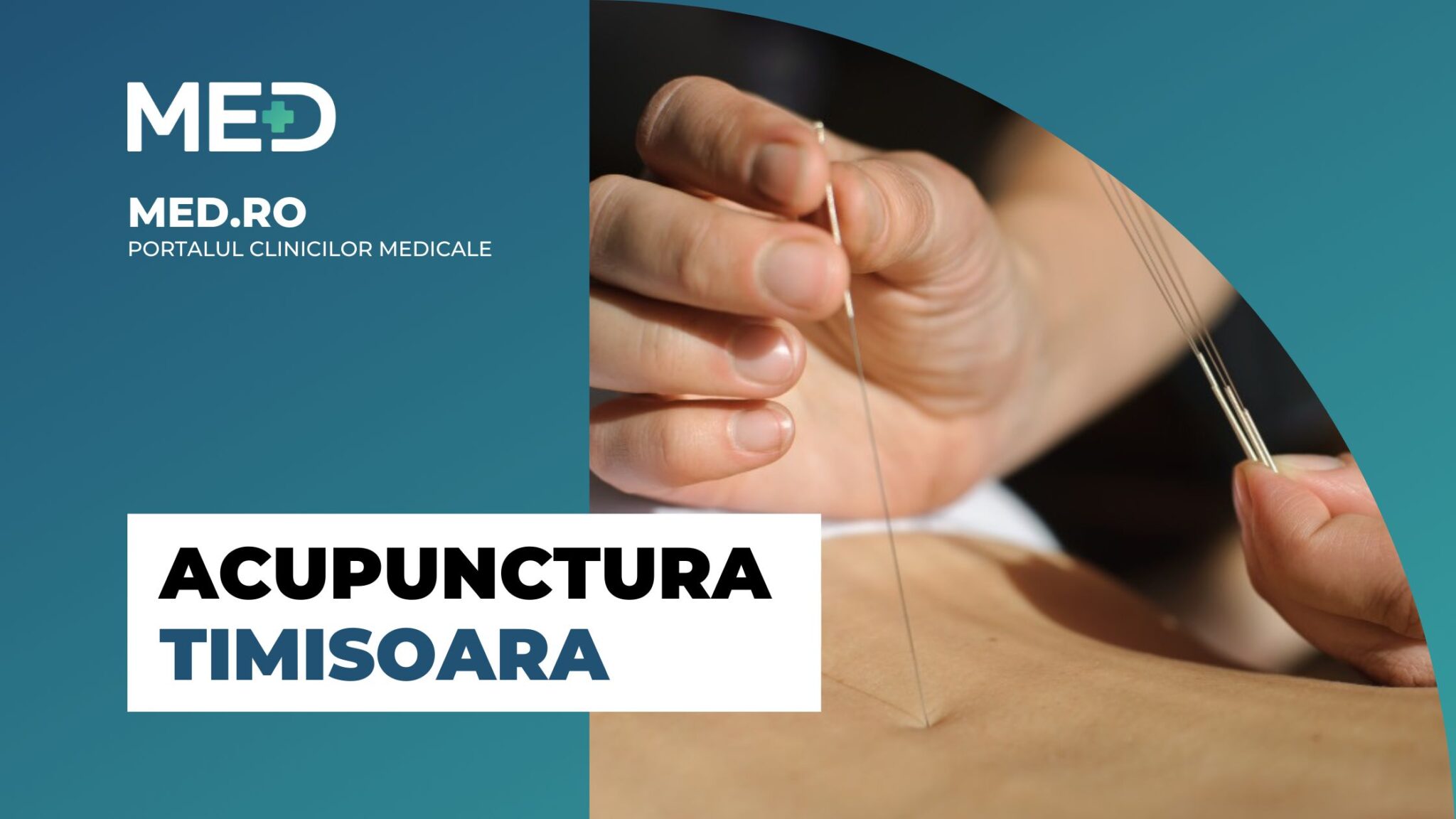 acupunctura